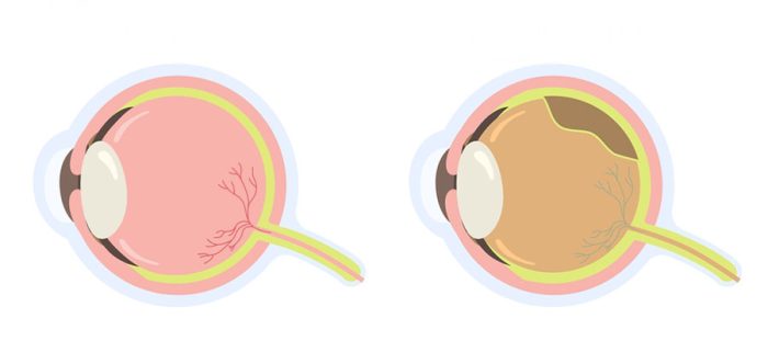 Retina Dekolmanı Belirtileri ve Tedavisi