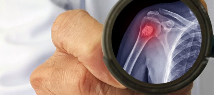 İyi Huylu Kemik Tümörü